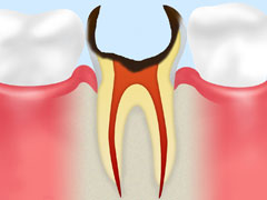 歯根の虫歯（C4）