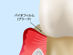 STEP1　軽度歯周病（歯周炎）