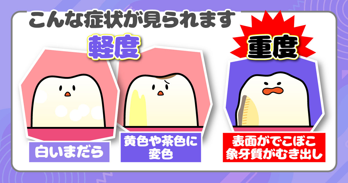 エナメル質形成不全