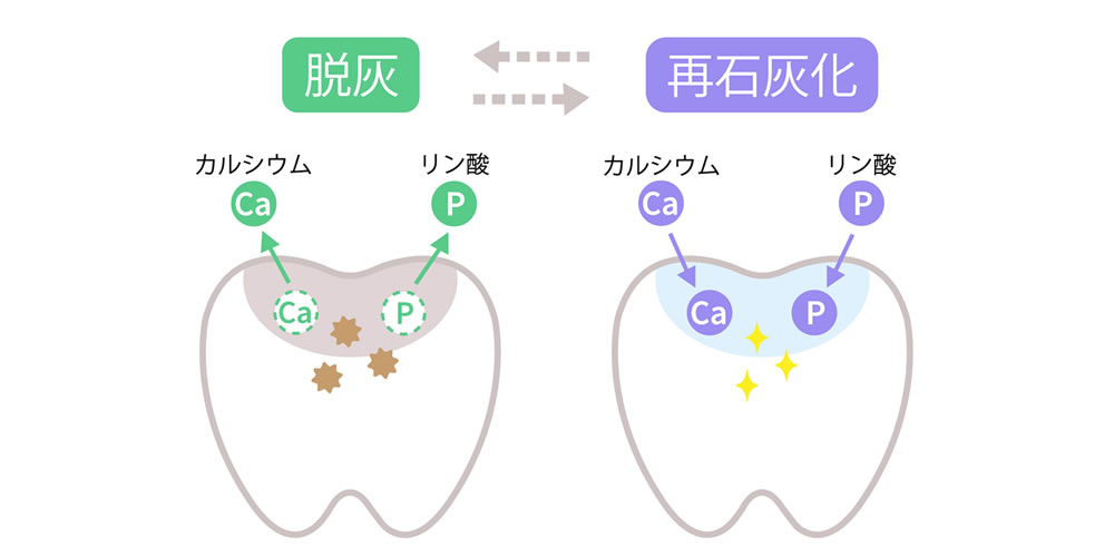 初期虫歯を進行させないための再石灰化について