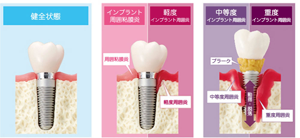 アフターケアと定期メンテナンスでインプラント周囲炎を予防